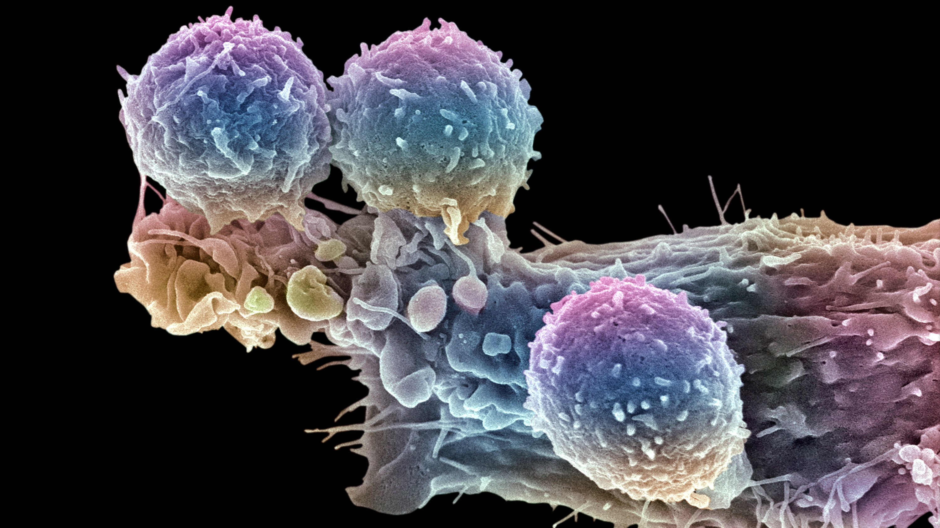 Linfocitos T y célula cancerosa.