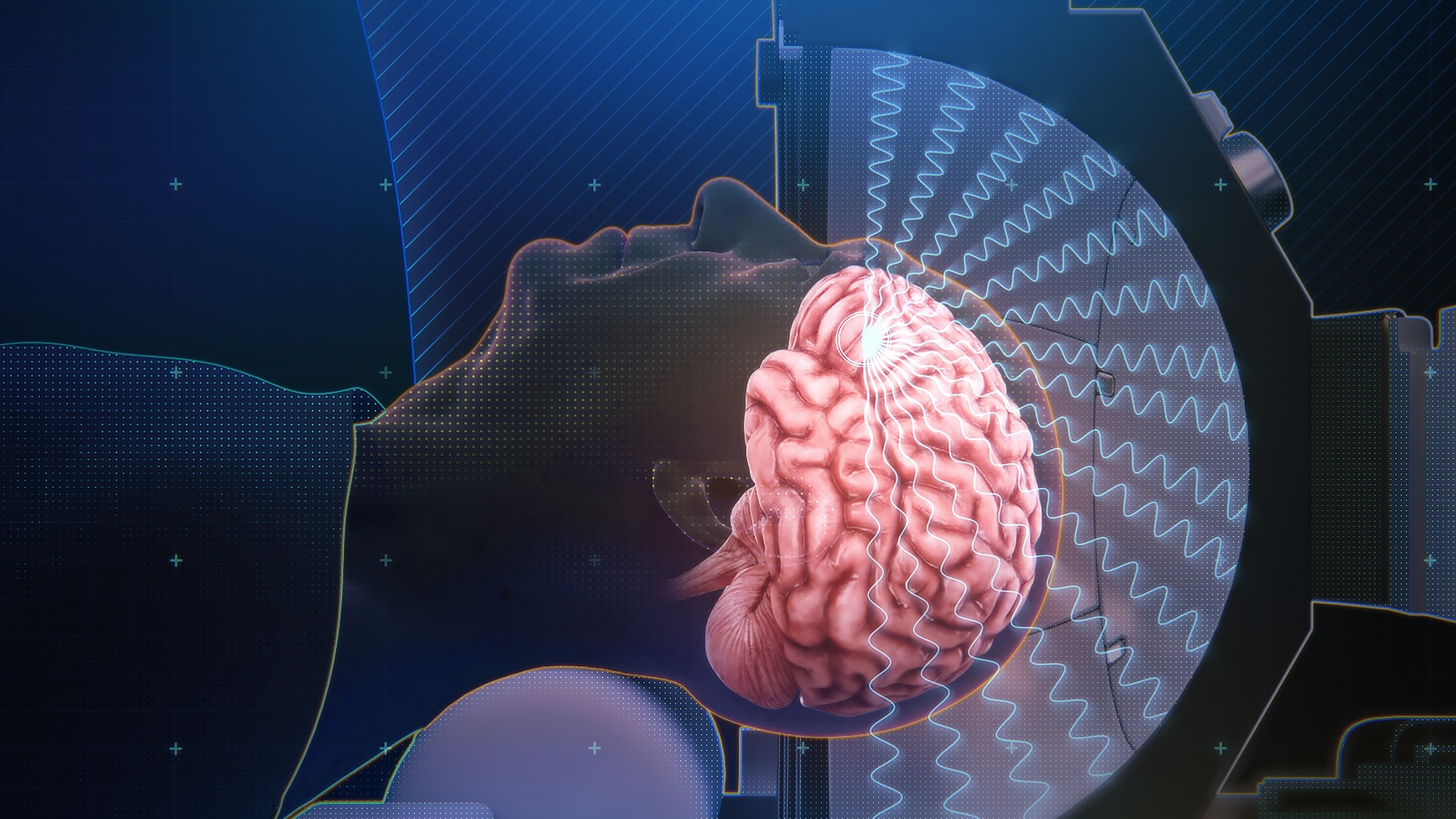 Ilustración de cómo las ondas ultrasónicas del casco convergen en un punto focal del cerebro para abrir la barrera hematoencefálica.