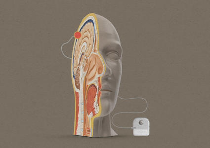 Sección transversal de una cabeza humana genérica con un cable que se extiende hasta el cerebro y desciende hasta el dispositivo Synchron.