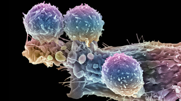 Linfocitos T y célula cancerosa.